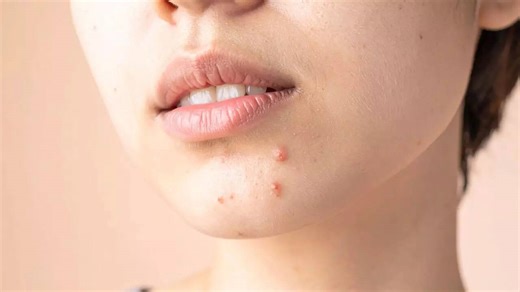 Acne scars treatment: How to remove them and post-acne care guide