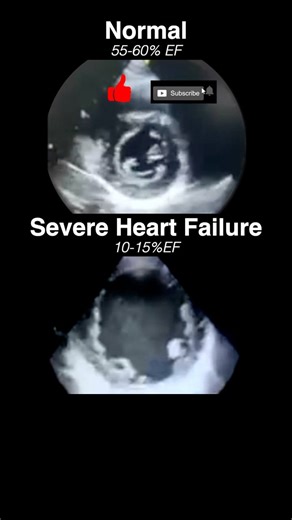 1M views · 1.5K reactions | Echocardiogram NORMAL vs SEVERE HEART FAILURE. ___________________________________#radiology #cardiology #radiologist #cardiologia #cardiologist #echocardiography #echocardiogram #hearthealth #heartfailure #pathology #science #medicalschool #medicalstudent #medicalscience #foamed #meded #usmle | MEDspiration | Facebook