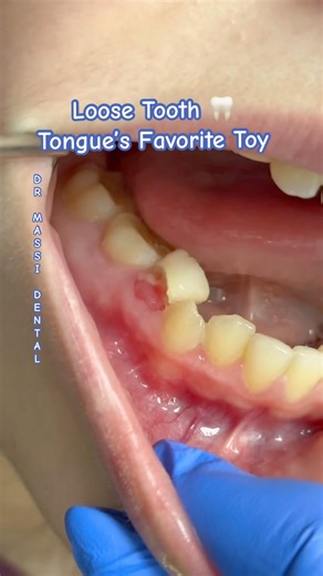 Wiggle wiggle “Loose baby Tooth: Tongue’s Favorite Toy”# funny #wiggle #funnymoment #wacky 😄