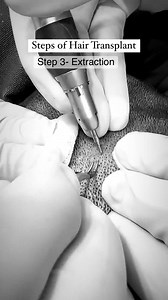 Presenting you the main steps of a hair transplant✨ Step 1- Designing Hair Line The most important step of hair transplant✨ Step 2- Making Slits The surgeon designs the recipient area according to the patient’s expectations and limitations of the donor area. The surgeon makes the holes or slits for the extracted grafts depending on the length of the grafts. Step-3 Extraction FUE differs from other surgical methods of hair transplant in the way the grafts are extracted. The surgeon uses a a 0.6 -