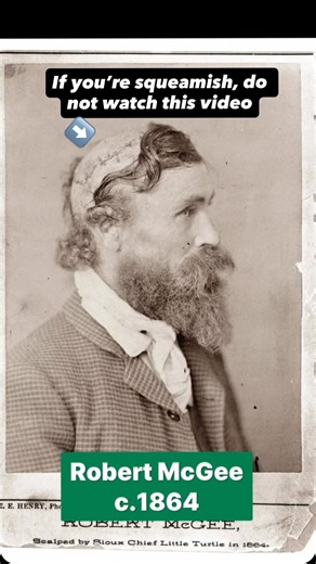 Bringing History To Life on Instagram: "Robert McGee was an American frontier worker and former soldier whose name became widely known because of the extraordinary injuries he survived during the Indian Wars. This studio portrait was taken after 1864, likely in the late 1860s to early 1870s, and shows McGee in profile to document the lasting effects of his ordeal. In 1864, McGee was captured during a conflict on the Great Plains and was scalped by a Sioux chief known as Little Turtle. Remarkably