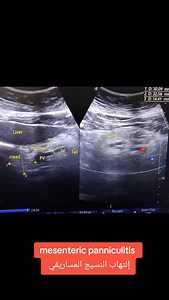 #Mesentric_panniculitis د.السيد إمام | د.السيد إمام