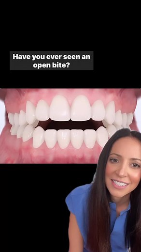 Understanding Open Bite: Causes, Symptoms, and Treatments