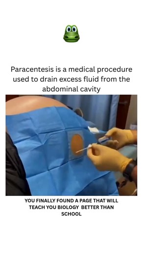BIOLOGY | MEDICAL | HEALTH on Instagram: "Paracentesis is a medical procedure that involves draining excess fluid (ascites) from the abdominal cavity, primarily for diagnostic or therapeutic purposes. The procedure uses a needle or catheter to remove this fluid, which can provide symptom relief and allow for laboratory testing to determine the cause of the fluid buildup, such as liver disease, infection, or cancer. How Paracentesis Works Purpose: It is performed to relieve discomfort and breathi