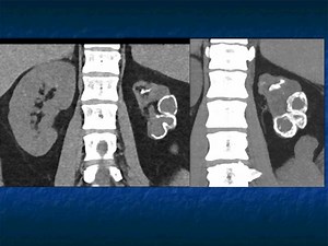 Hematuria From "Abdominal Pain in the ED: GU Pathology - Part 2" View the full lecture: https://ctisus.com/media/2024/02/12/abdominal-pain-in-the-ed | CTisus: Cutting edge information on body CT (Computed tomography).
