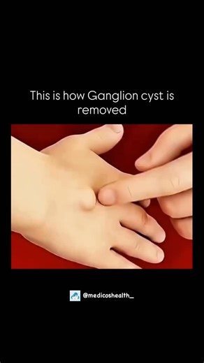 Medical & Health ⚕️ | Ganglion cyst removal is a common procedure used to treat lumps that form around joints or tendons, most often in the wrist or hand. These... | Instagram