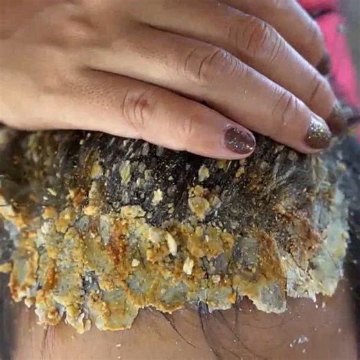 Dandruff combing scratching hair!! itching scratching dandruff scalp #107 #ticks #removetick #Dandruff #dandrufftreatment #dandruffremoval | Help remove ticks