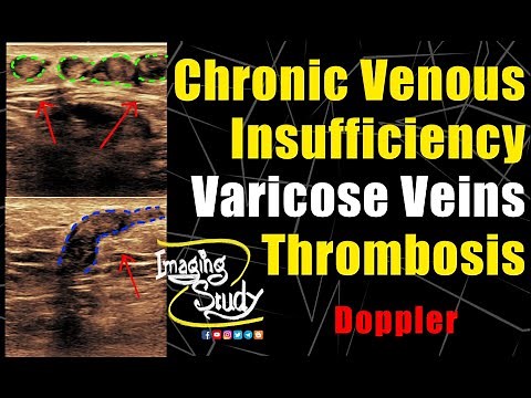 Chronic Venous Insufficiency - Varicose Veins - Thrombosis || Ultrasound || Doppler || Case 252