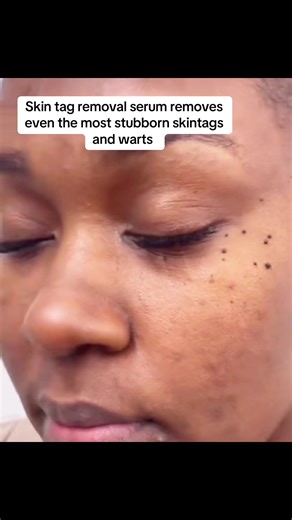 Fast and Easy Skin Tag Removal with Our Serum