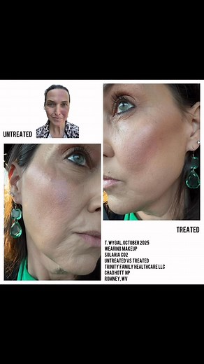 Solaria CO2 laser—-real life results in 4 weeks! #inmode #nursepractitioner #trinityfamilyhealthcare #co2laser | Trinity Family Healthcare, LLC