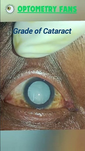 Grade of Cataract