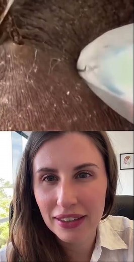 Huge Nest of Ingrown Hair