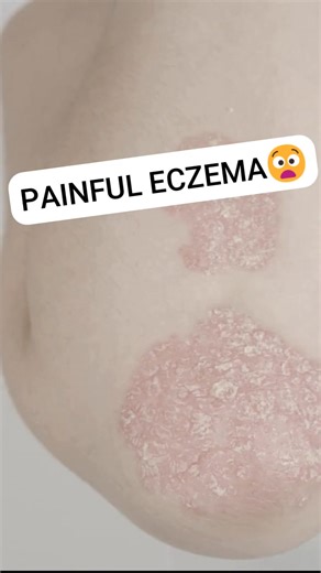 605 reactions · 22 shares | Tired of the endless cycle of itching and irritation? You’ve spent so much on creams that never really helped. ✨ Meet DermaBalm — the fast-acting, dermatologist-inspired cream trusted by thousands. It soothes, heals, and protects your skin without steroids.  Safe for daily use. Powerful for every skin problem. Order now and finally feel relief that lasts. | DermaBalm Philippines | Facebook