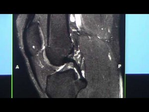 Knee MRI Part 1 for Orthopaedic and Radiology Residents