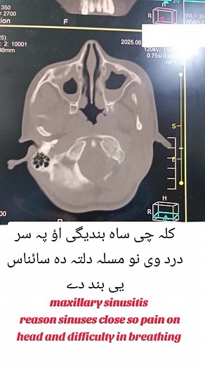 Understanding Maxillary Sinusitis: Causes and Treatments