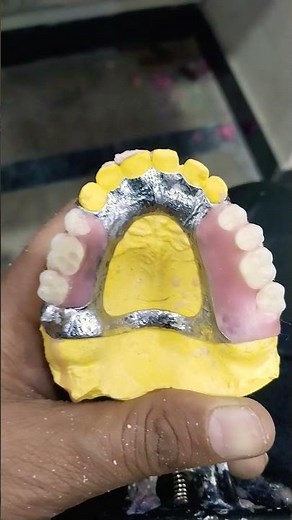 Teeth Arrangement Of Upper Removable Cost Partial Denture 😁😁😁#cost#partialdenture#rpddentalprocedure