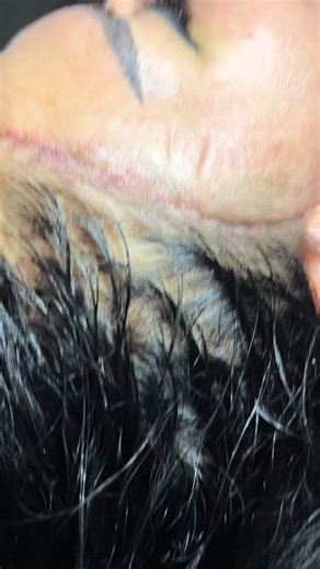 Hairline Cosmetic Treatment Procedure Explained