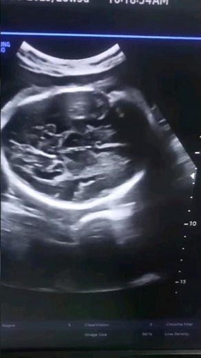 Fetal head // fetal brain//ultrasound