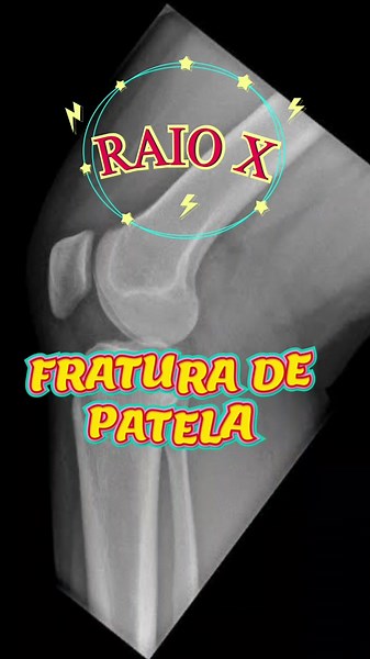 #medicina #osso #fratura #medicinaexplicada #ortopedia #radiologia #raiox