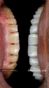 78K views · 644 reactions | Last week’s case. #drmohammednaji #dentistry #dubaidentist #veneersdubai | Dr. Mohammed Naji | Facebook