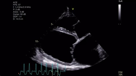 Michal Fiedler on Instagram: "Dilated Cardiomyopathy (DCM) in Dogs: A Closer Look Dilated cardiomyopathy (DCM) is a serious heart condition commonly seen in breeds like Dobermans, Great Danes, and Boxers. It’s characterized by weakened heart muscle function, leading to chamber dilation and reduced cardiac output. Echocardiography is essential for diagnosing and monitoring DCM. Key findings often include: • Dilated and hypocontractile ventricles (both left and right in advanced cases) seen in sho