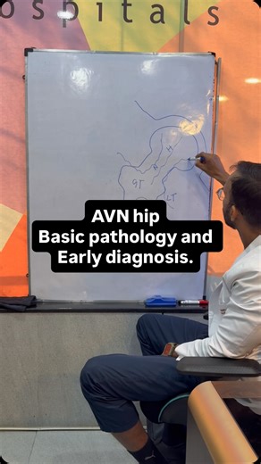 Understanding AVN of the Hip — why early diagnosis matters The hip joint gets its blood supply mainly through the neck of the femur, with a small contribution from vessels near the acetabulum. This means the head of the femur is a low–blood-flow zone. ⚠️ When this blood supply is compromised — • long-term steroid use • alcohol excess • minor fractures • post-COVID changes • idiopathic causes ➡️ the bone cells don’t get oxygen, they die, and this leads to Avascular Necrosis (AVN) of the hip. 🔍 E