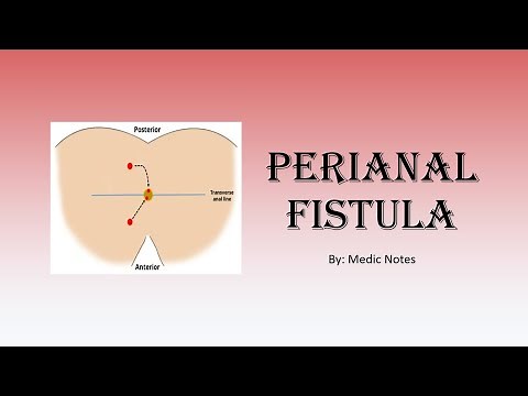 Perianal fistula - etiology, clinical features, Goodsall rule, surgery