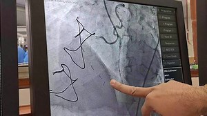 3K views · 201 reactions | Complex long severely calcified lesion, with sky high J CTO Score in post CABG Patient....for Cardiology and Interventional Cardiology Feternity... | Dr Fawad Farooq | Facebook
