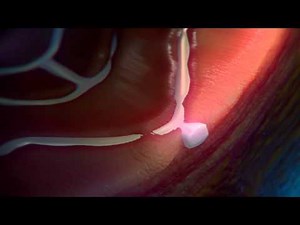 Bio resorbable Stent implantation