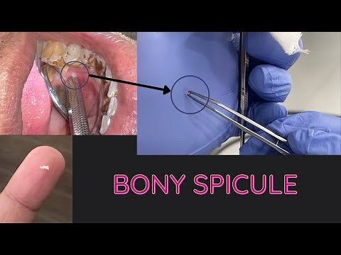 Bone Spicule | Minor Surgery |