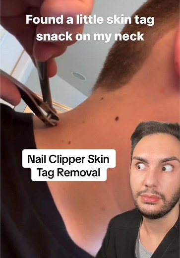 Safe At-Home Skin Tag and Mole Removal Options