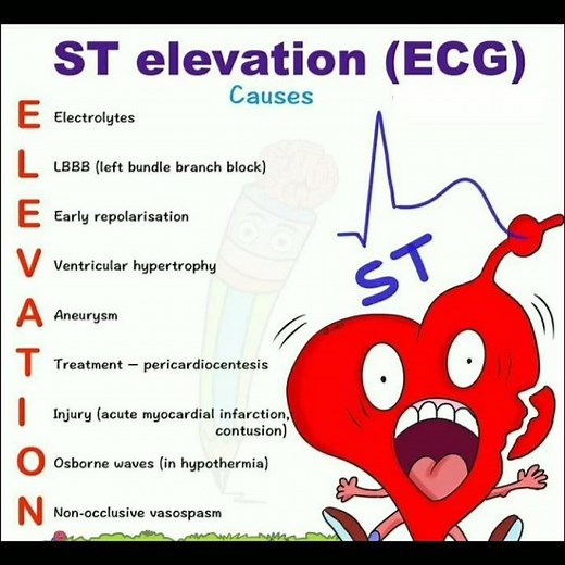 ST elevation in ECG myocardial infarction