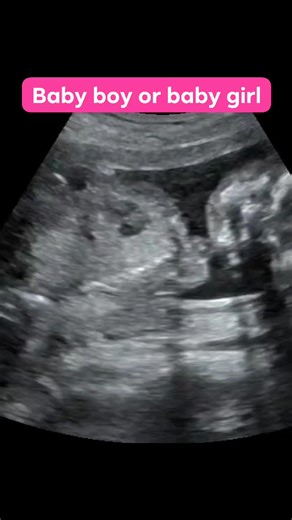 Baby boy or baby girl? 22 weeks Ultrasound video. #BabyBumpLove #MiracleOfLife #UltrasoundJoy #BabyOnBoard #PregnancyUpdate #ExcitingTimes #GrowingFamily #BlessedWithBaby #MomToBe #DadToBe | Dr Usama Fahim Chishti
