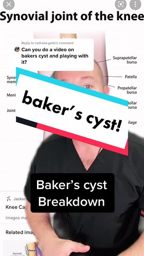 Expert Orthopedic Surgeon Removes Baker's Knee Cyst!