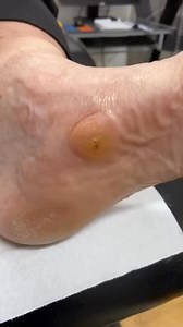 Learn how a Podiatrist expertly removes Medial Foot Callus Removal | Corn and Callus Treatment . . #footpain #plantarfasciitis #heelpain #podiatry #footcare #podiatrist #orthotics #feet #foothealth #kneepain #foot #running #anklepain #backpain #bunions #flatfeet #healthyfeet #footpainrelief #arthritis #health #footdoctor #bunion #fyp #foryou #viralreels #explore | Docpods Treatment