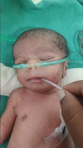 🩺 Premature Baby Oral Suction | How to Do Suction for Preemie Baby #PrematureBaby #OralSuction