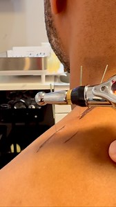 4.4K views · 31 reactions |  Dry Needling: A Reset for Overworked...