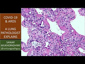 COVID-19 can kill: a lung pathologist explains what ARDS means and why it's important