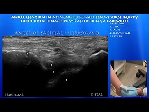 Ultrasound of a Ankle Joint Effusion in a 12 Year Old Female, by probeultrasound