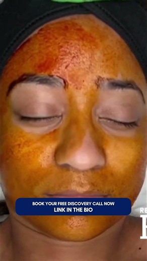 Professional Microneedling + Dermaplaning PART 2
