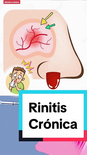 Rinitis crónica en bebés: Causas y tratamiento | Dr. Carlos Galindo