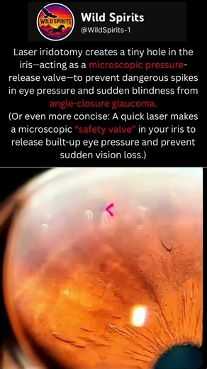 Laser Creates a Pressure-Release Hole Inside the Eye 👁️🔬