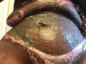 Botched: Is a Tummy Tuck Worth the Risk?