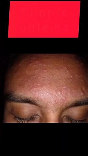 benzac ac 2.5 gel review #pimplesremoval #acne