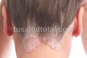 9 Remedios Caseros para la Psoriasis en el Cuero Cabelludo