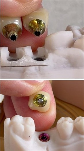 Zirconia crowns that we just completed in my lab