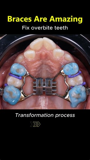 Amazing braces. don't stop dentist fix any teeth case #braces #dentist #orthodontist #orthodontics