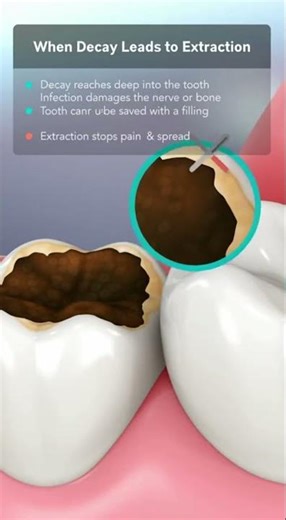 🦷 Does a Decayed Tooth Always Need to Be Pulled?