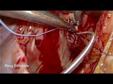Endoscopic Beating Heart TV Repair with Ascending Aortic Cannulation in a 95-Year-Old Patient
