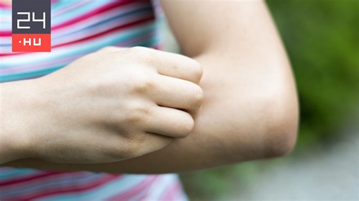 Ezért viszket egyeseknek jobban a szúnyogcsípés | 24.hu